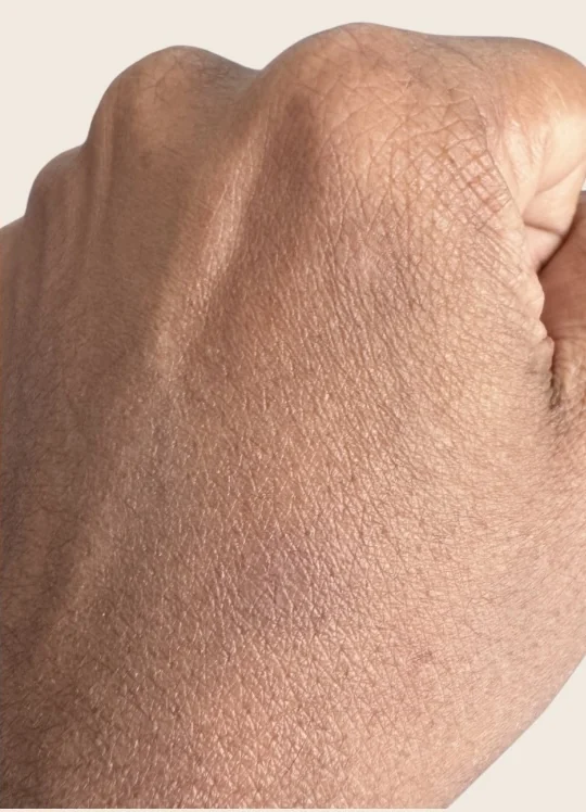 Back of the same hand after one Picofy pico laser session at Rejuvena Clinic, Bedford, with the pigmented marks visibly lighter