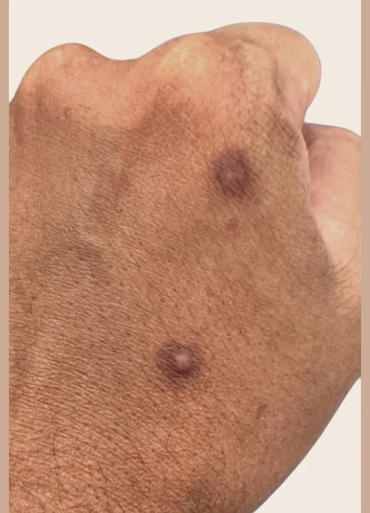 Back of a hand with dark pigmented marks before pico laser treatment with Picofy at Rejuvena Clinic, Bedford