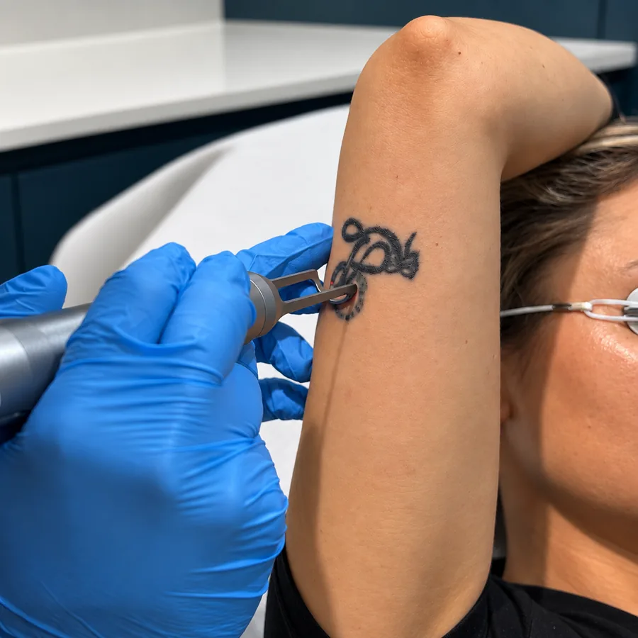 Picolaser tattoo removal on a forearm tattoo at Rejuvena Clinic, Bedford