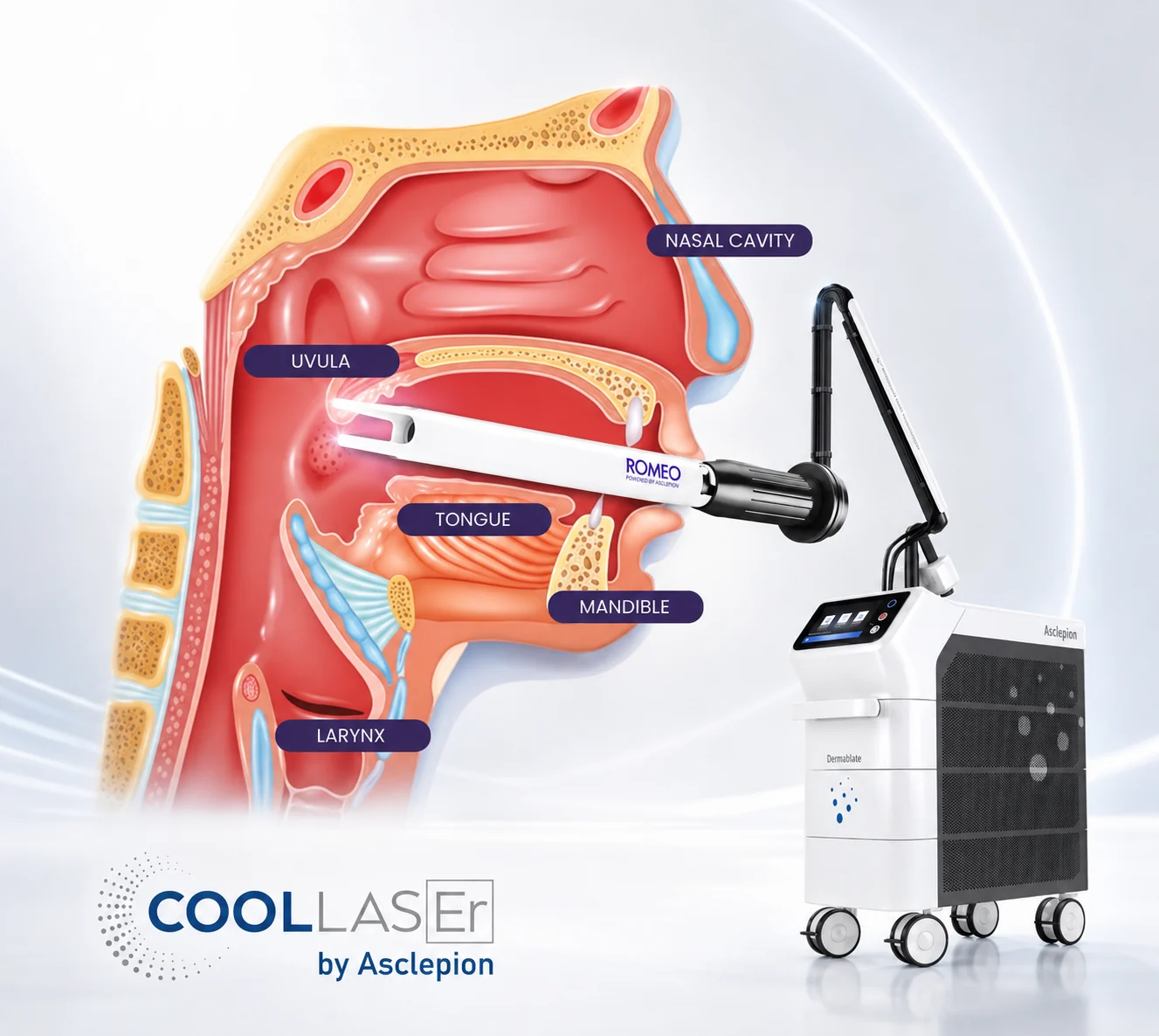 Anatomical diagram of the airway — nasal cavity, soft palate, uvula, tongue and larynx — with the Romeo Er:YAG laser handpiece positioned to treat the soft palate