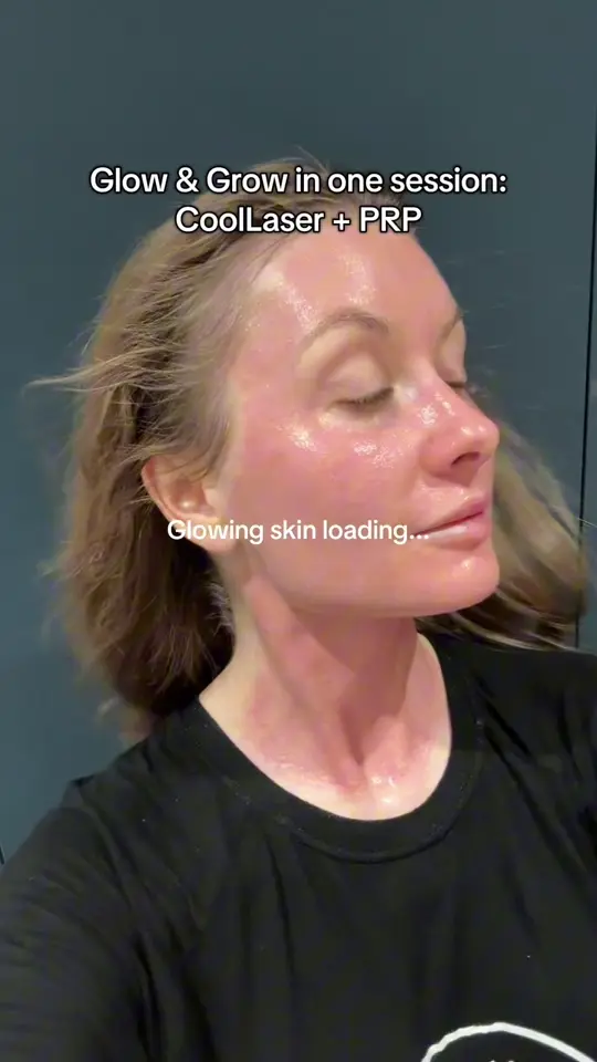 Glow and Grow: CoolLaser and PRP signature treatment at Rejuvena, Bedford