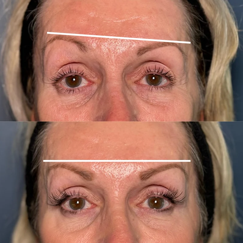 Anti-wrinkle injection before and after result at Rejuvena, Bedford