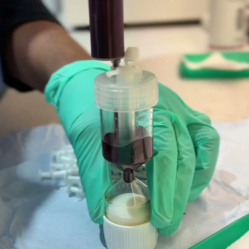 Doctor-led PRP being prepared in the WorldPRP separation tube at Rejuvena, Bedford
