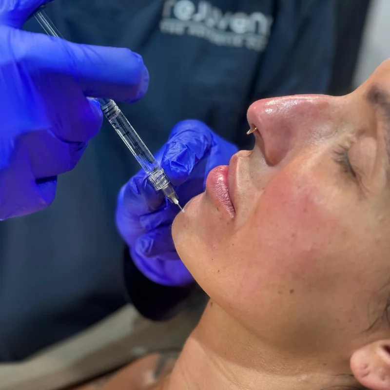 Doctor-led collagen-stimulating biostimulator injection to the lower face at Rejuvena, Bedford