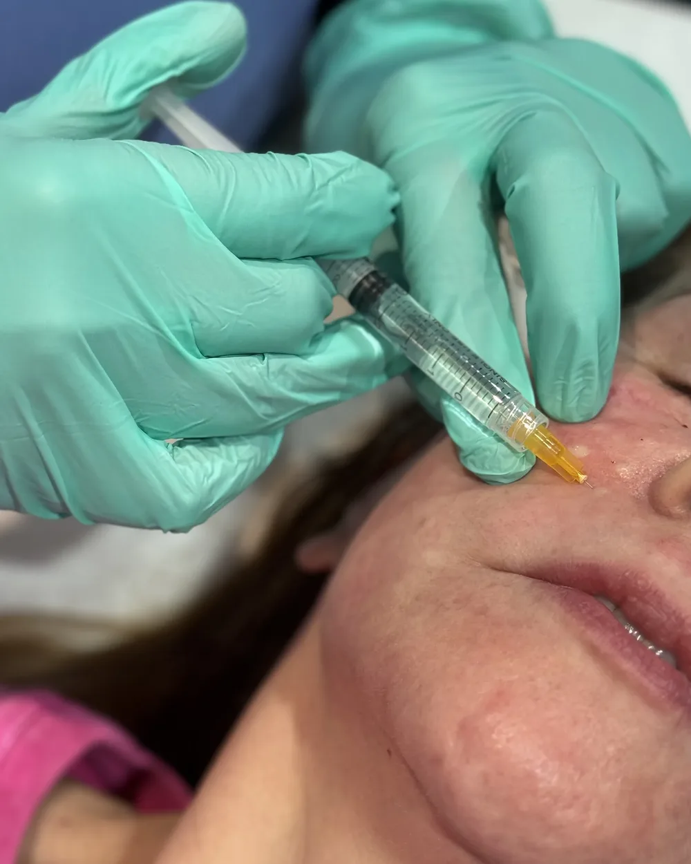 Close-up of a fine needle placing a polynucleotide skin booster at the cheek during a doctor-led treatment at Rejuvena Bedford