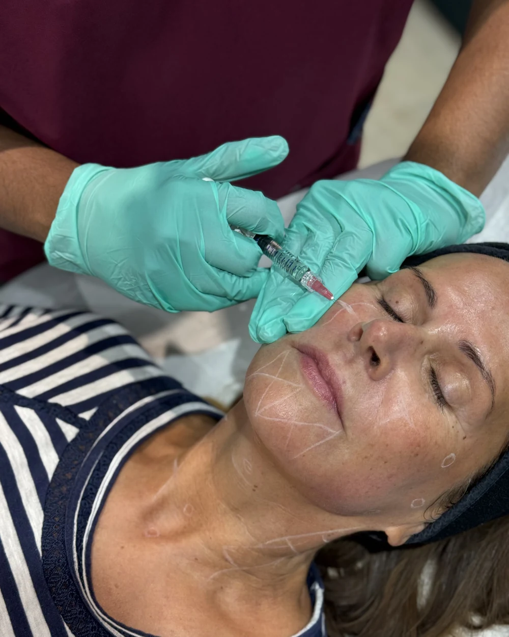 Dr Nick performing a Profhilo bio-remodelling injection at Rejuvena Clinic, Bedford