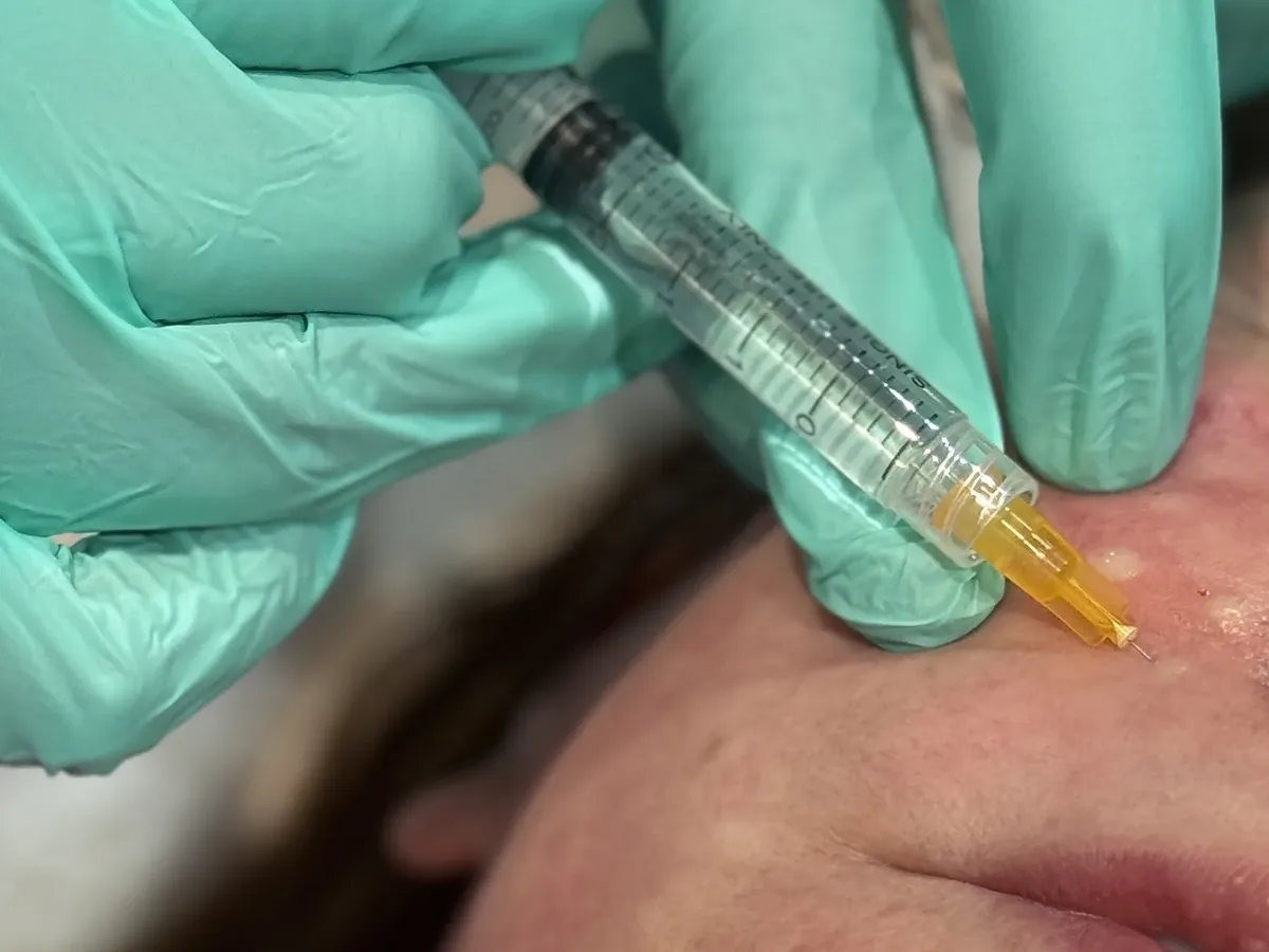 Close-up of a doctor-led skin-booster injection technique at Rejuvena Clinic, Bedford