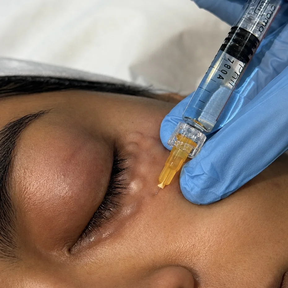 Close-up of a polynucleotide skin-booster injection beside the under-eye area at Rejuvena Bedford
