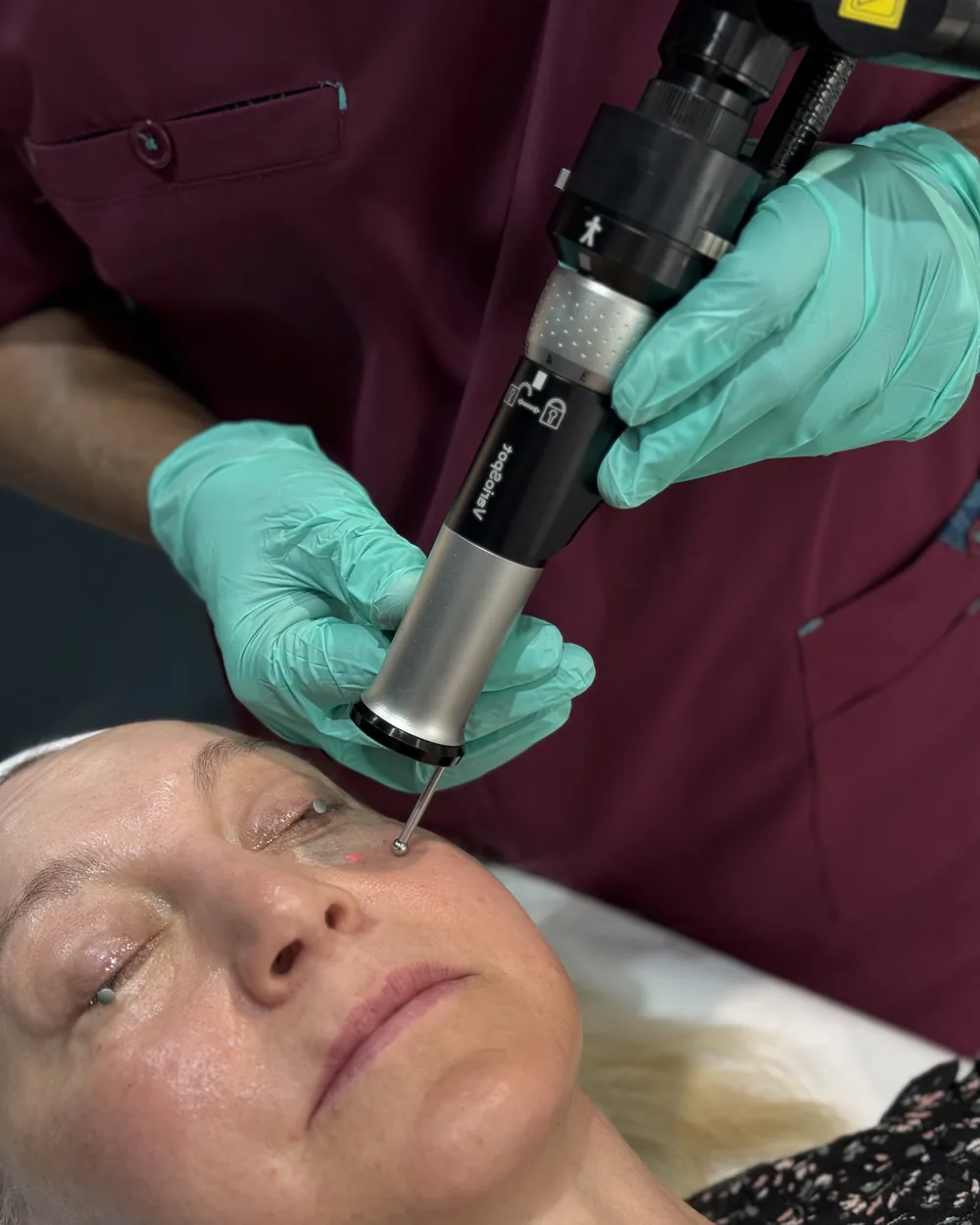 Er:YAG laser handpiece resurfacing the lower eyelid, with protective metal intraocular eye shields in place, at Rejuvena Clinic in Bedford