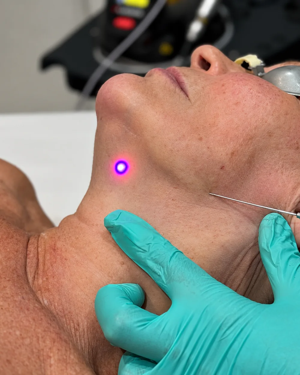 A fine optical fibre delivering laser energy beneath the skin of the neck during an EndoContour K-Laser Blue procedure at Rejuvena Clinic in Bedford