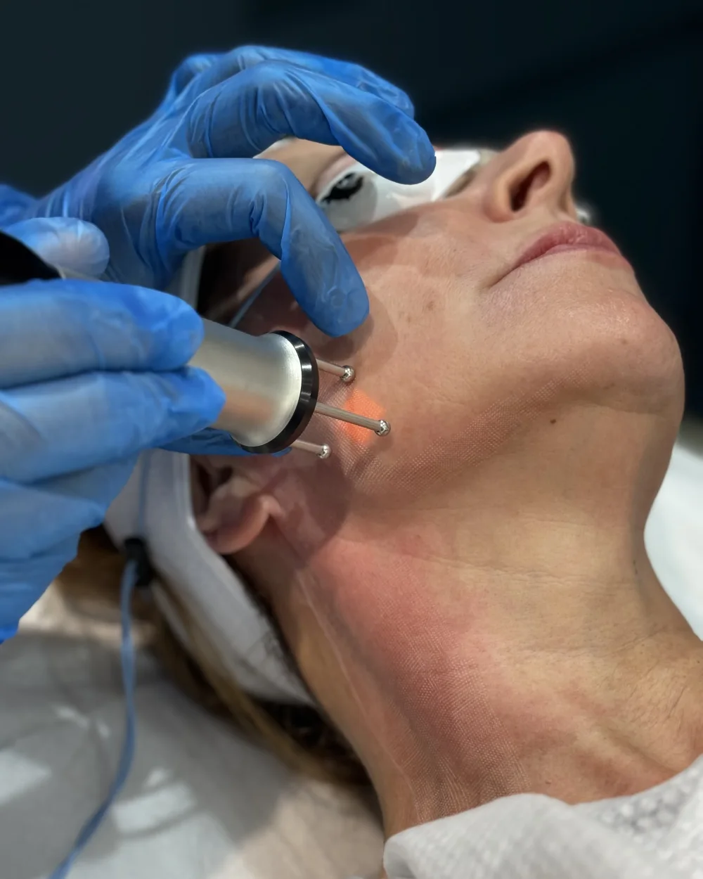 Clinical assessment before stretch mark treatment