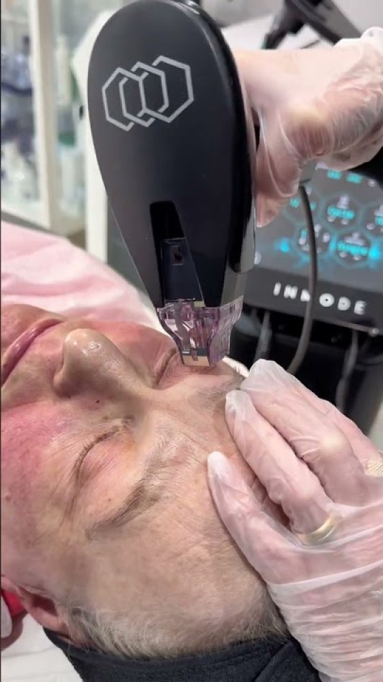 Morpheus8 RF microneedling, up close