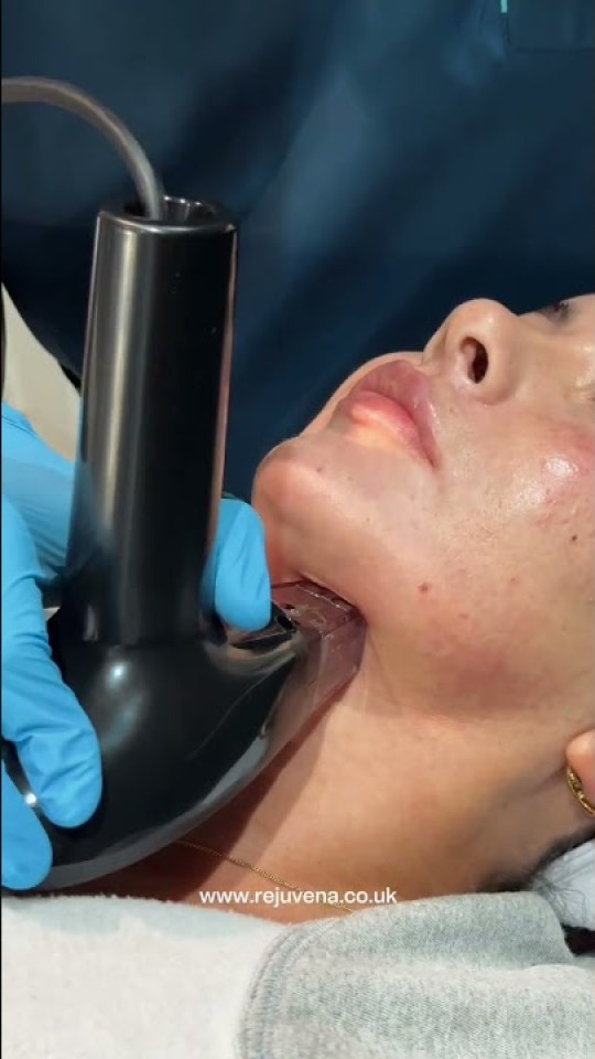 Morpheus8 contouring along the jawline