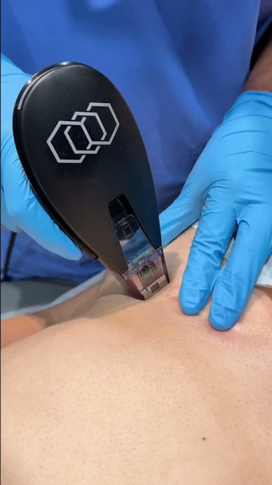 Morpheus8 microneedling in action