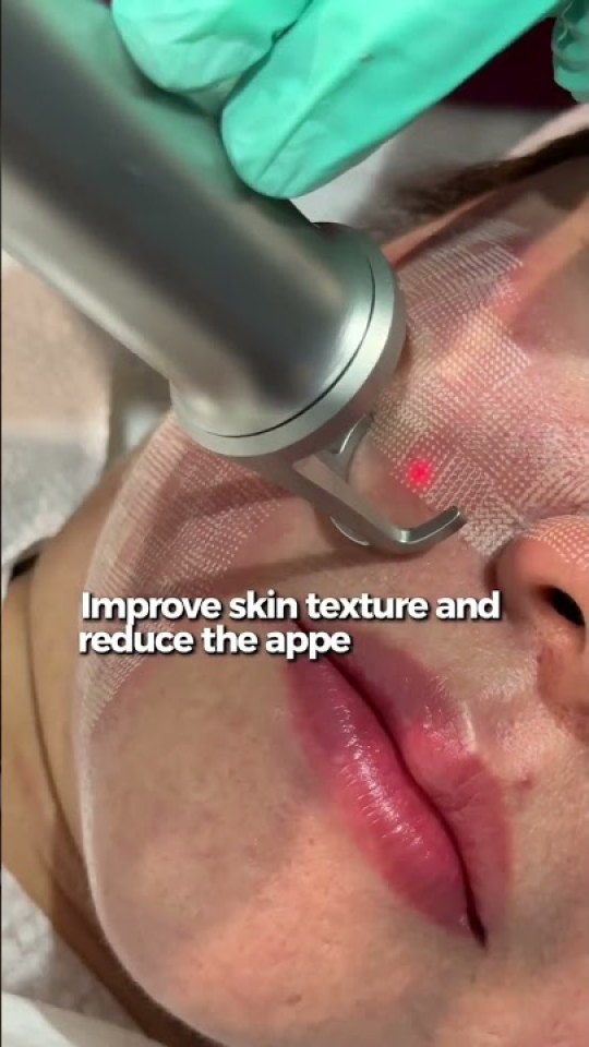 Fractional laser to smooth scar texture