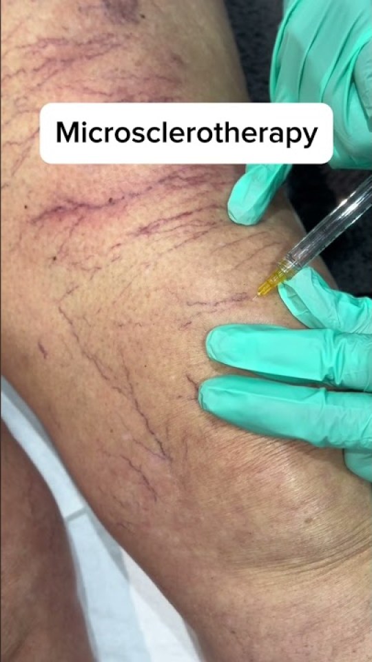 Microsclerotherapy for leg thread veins