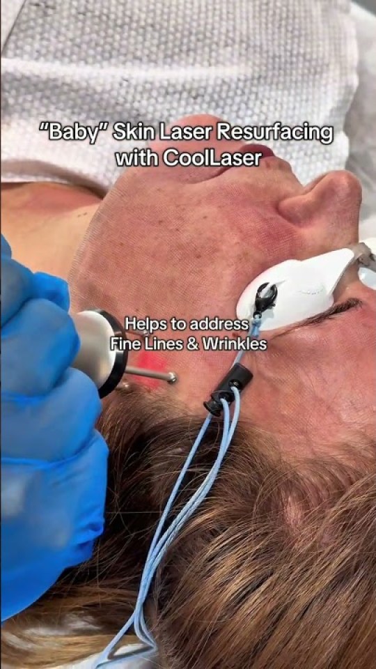 "Baby" laser resurfacing for fine lines