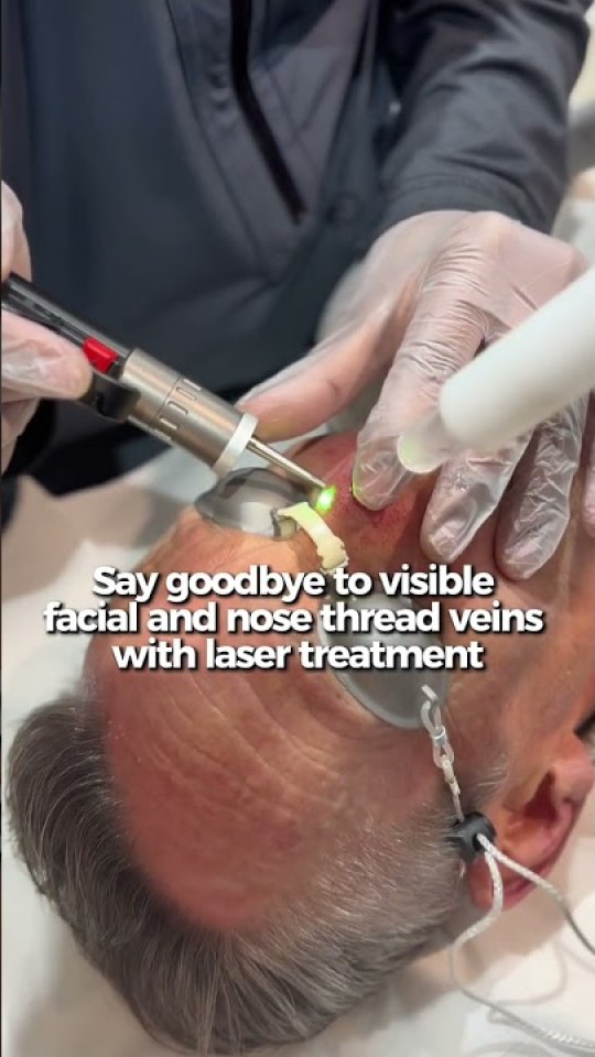 Laser treatment for facial and nose thread veins