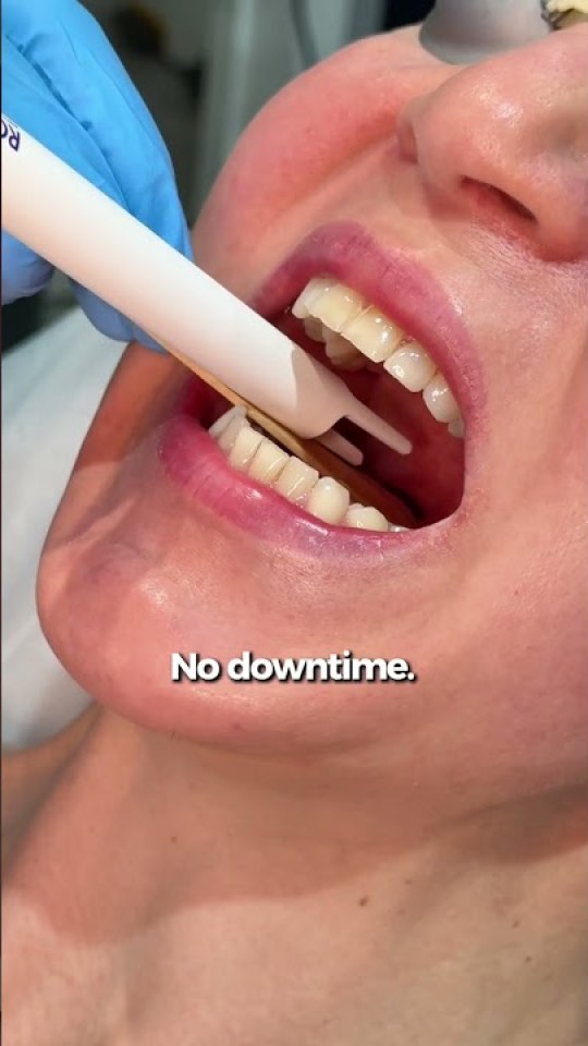 See the Romeo™ anti-snoring laser