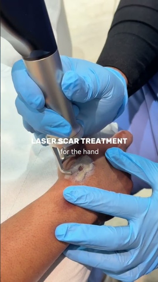 Laser scar treatment for the hand