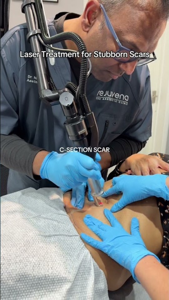 Laser treatment for a C-section scar