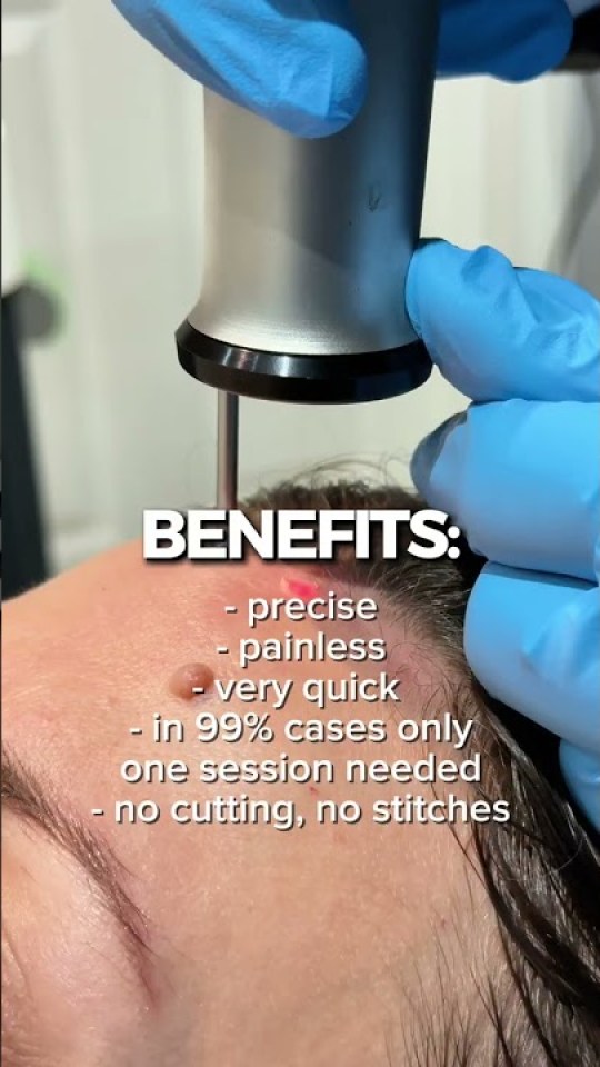See doctor-led mole removal