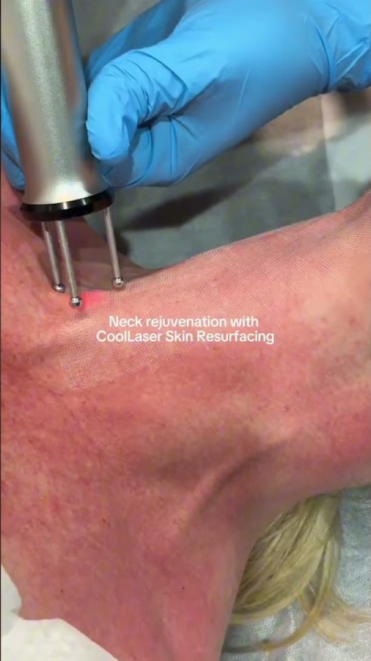 Neck rejuvenation with CoolLaser resurfacing